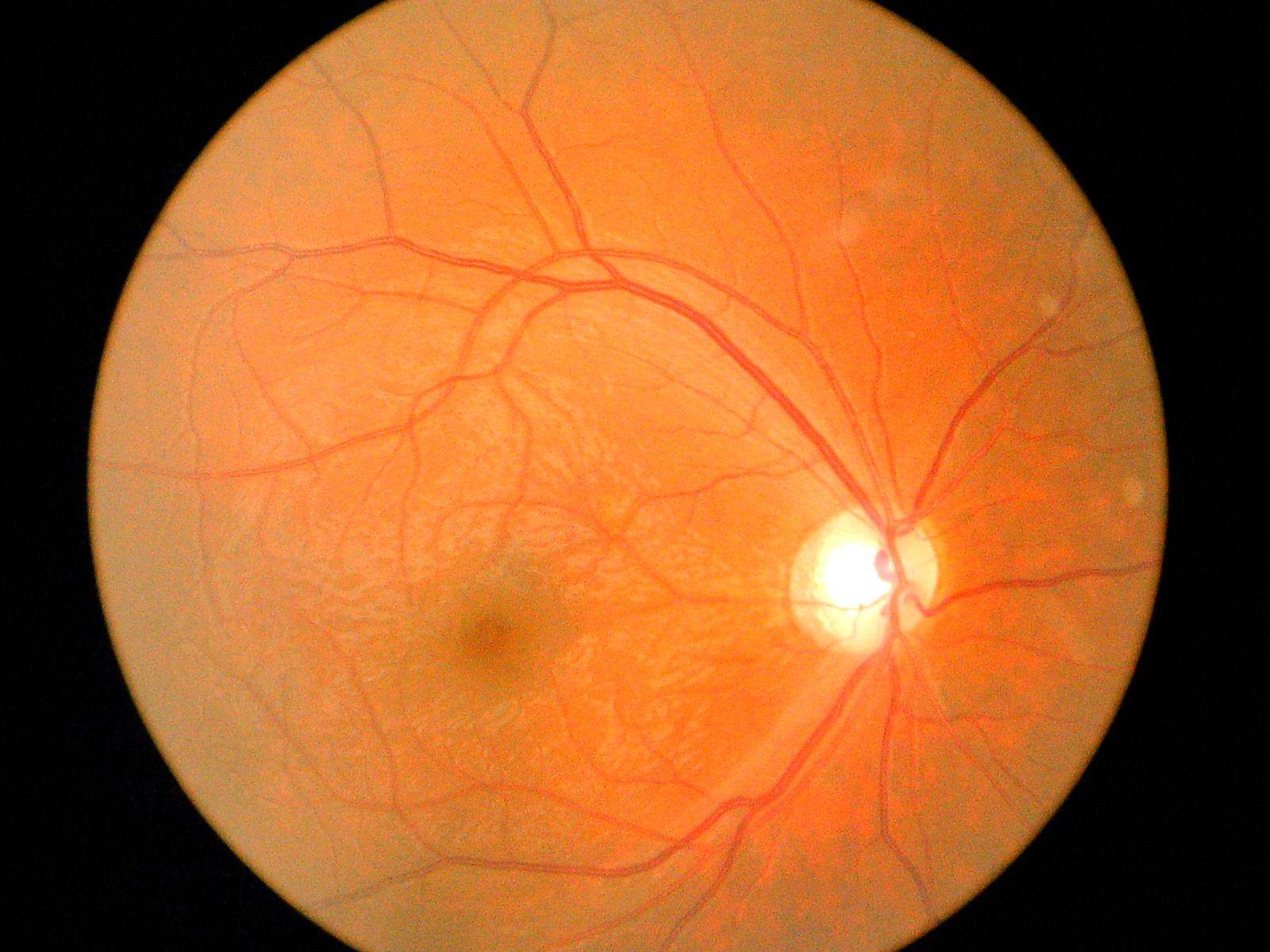 其它引起视神经萎缩的原因有:视神经发炎,视神经循环障碍,青光眼,视